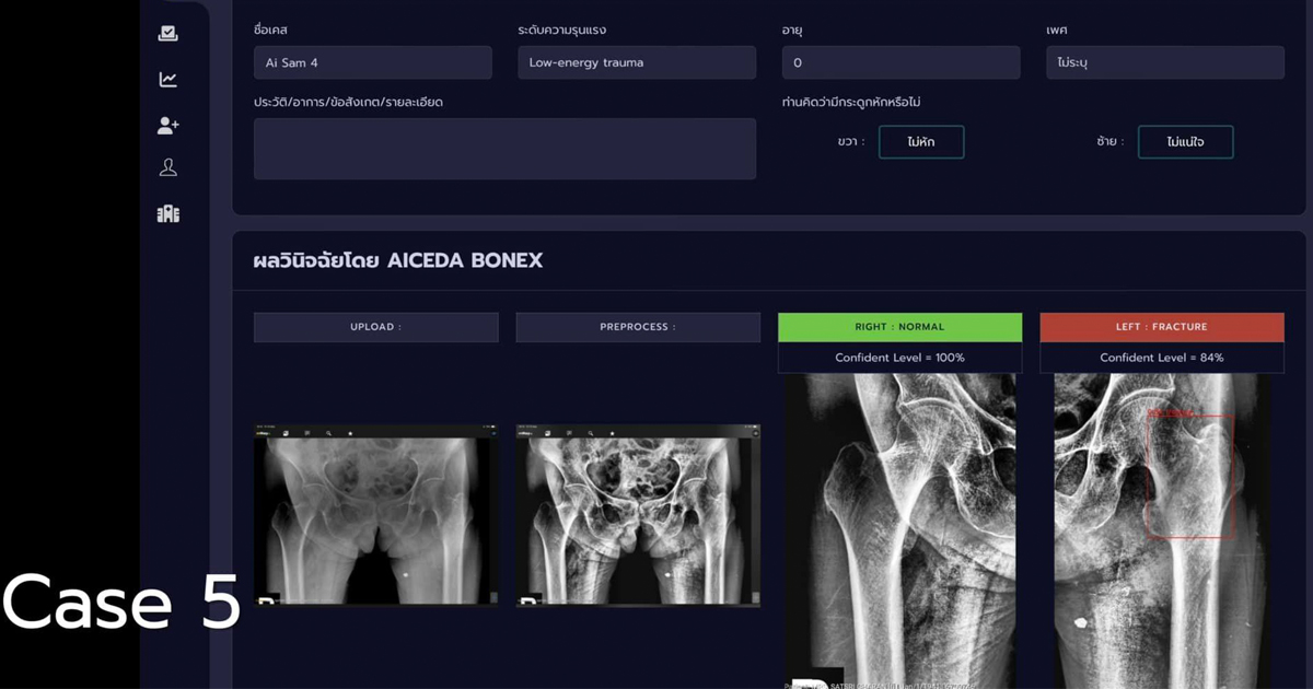 เปิดตัวนวัตกรรมทางการแพทย์ AICEDA BoneX ช่วยวินิจฉัยผู้ป่วยกระดูกสะโพกหักจากภาพเอกซเรย์